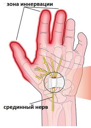Как ослабить проявление симптомов туннельного синдрома запястья во время беременности