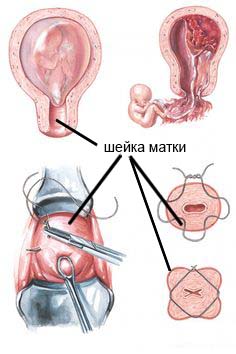 Как продлить беременность со слабой шейкой матки