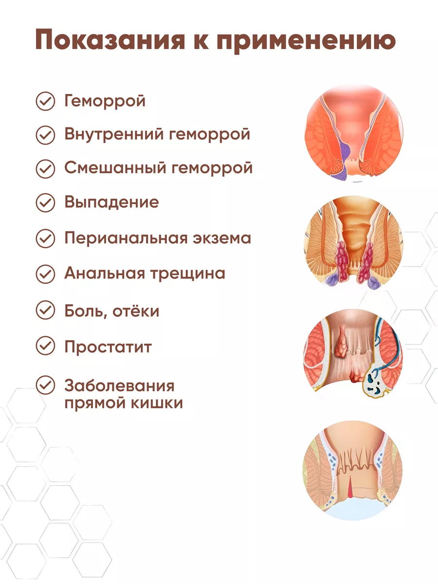 Как лечить геморрой у беременных женщин