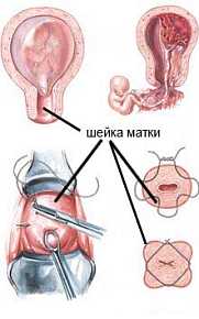 Как продлить беременность со слабой шейкой матки