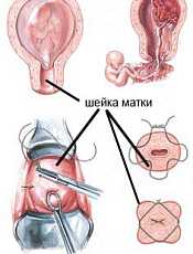 Как продлить беременность со слабой шейкой матки